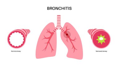 Bronşit kavramı, akciğer enfeksiyonu. Bronşik anatomik poster. Sinirli, şişmiş ve iltihaplı solunum yolları. Nefes darlığı, öksürük, göğüs ağrısı ve akciğerlerde mukus düz vektör çizimi.