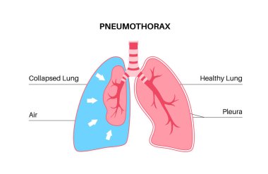 Pneumothorax disease flat vector. Collapsed lung medical poster. Air in the space between lung and chest wall. Chest pain, shortness of breathing. Unhealthy internal organs in respiratory system clipart