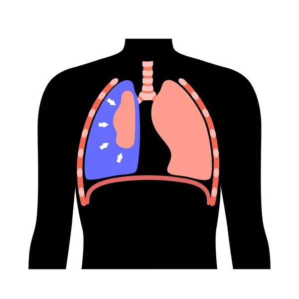 Pneumothorax Erkrankung Flacher Vektor Zusammengebrochene Lunge Medizinische Poster Luft Raum — Stockvektor