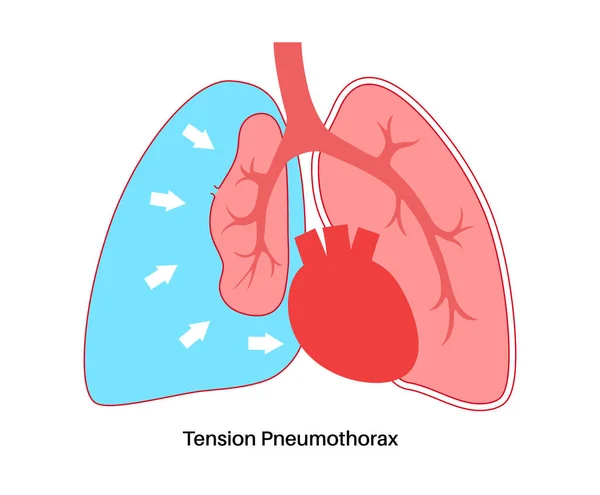 緊張性気胸疾患 血の量を減らすことは心臓に戻った 肺や胸壁の損傷 胸の痛み 呼吸の不足 呼吸器系ベクトルの不健康な内臓 — ストックベクタ