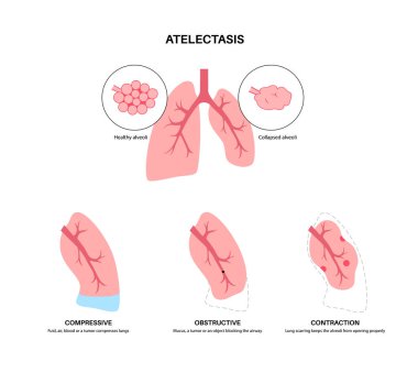 Atelektazi hastalığı anatomik poster. Tamamen ya da kısmi çöküş ya da akciğerin kapanması. Azaltılmış ya da gaz değişimi yapılmamış. Ciğerler alveol sıvısıyla dolu. Solunum sistemi düz vektör çizimi