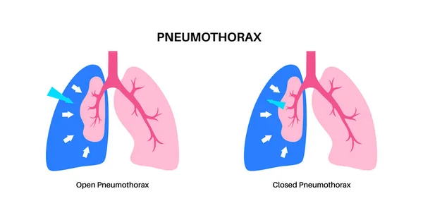 stock vector Pneumothorax disease flat vector. Collapsed lung medical poster. Air in the space between lung and chest wall. Chest pain, shortness of breathing. Unhealthy internal organs in respiratory system