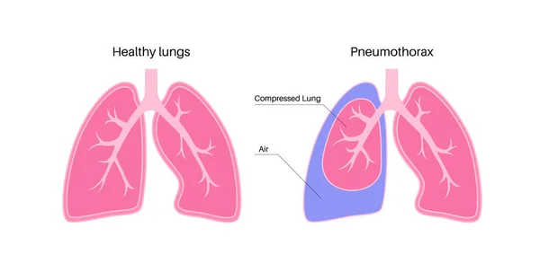 벡터에요 폐색된 포스터 사이의 공간에 호흡기 계통의 불건전 — 스톡 벡터