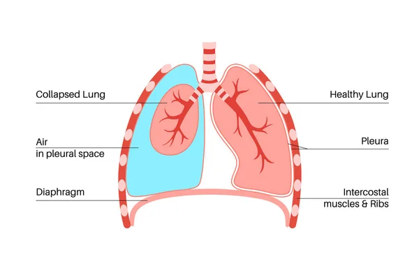 stock vector Pneumothorax disease flat vector. Collapsed lung medical poster. Air in the space between lung and chest wall. Chest pain, shortness of breathing. Unhealthy internal organs in respiratory system
