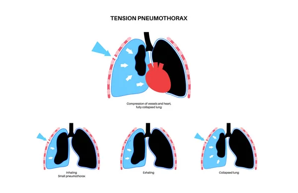 紧张性肺胸病 减少血液回流到心脏的数量 肺或胸壁受伤 胸部疼痛 呼吸急促 呼吸系统载体中的不健康内脏器官 — 图库矢量图片