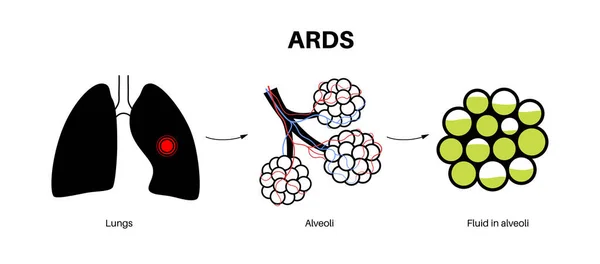 Stock vector Acute respiratory distress syndrome. Lungs cannot enough oxygen. ARDS medical poster. Exudative, proliferative, and fibrotic stages. Unhealthy internal organs. Respiratory system vector illustration