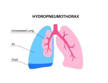 Hidropnömotoraks akciğer hastalığı. Plevral boşlukta hava ve sıvı karışımı. İnterkostal drenaj tedavisi konsepti. Sağlıksız iç organlar. Solunum sistemi vektör illüstrasyonunun rahatsızlığı