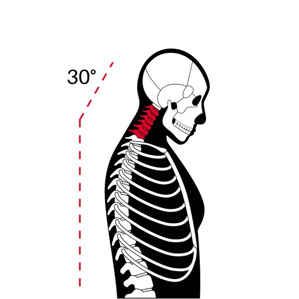 Diagram Över Deformering Halskotorna Nackkramp Ryggont Stelhet Och Täthet Axlarna — Stock vektor