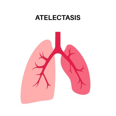 Atelektazi hastalığı anatomik poster. Tamamen ya da kısmi çöküş ya da akciğerin kapanması. Azaltılmış ya da gaz değişimi yapılmamış. Ciğerler alveol sıvısıyla dolu. Solunum sistemi düz vektör çizimi