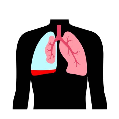 Hemopnömotoraks akciğer hastalığı. İki tıbbi durum pnömotoraks ve hemotoraks karışımı. Öksürük, göğüs ağrısı, nefes darlığı. Sağlıksız iç organlar. Solunum sistemi illüstrasyonu