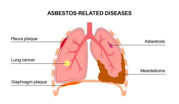 Boli Legate Azbest Pleura Placa Diafragmă Cancerul Pulmonar Azbestoza Celulele — Vector de stoc