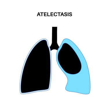Atelektazi hastalığı anatomik poster. Tamamen ya da kısmi çöküş ya da akciğerin kapanması. Azaltılmış ya da gaz değişimi yapılmamış. Ciğerler alveol sıvısıyla dolu. Solunum sistemi düz vektör çizimi