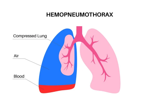 吐き気性肺疾患 2つの医療条件の組み合わせ気胸と血胸 胸の痛み 呼吸困難 不健康な内臓だ 呼吸器系図 — ストックベクタ