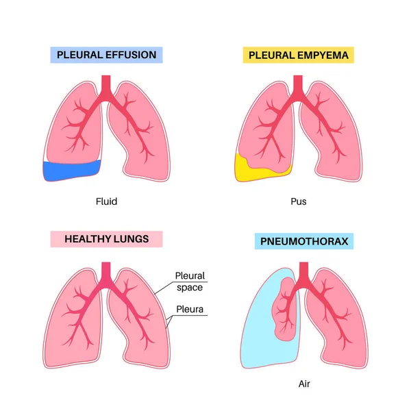 胸腔积液海报 肺和胸腔组织层之间的流体 常见的肺部疾病 胸部疼痛 呼吸困难 呼吸系统内不健康的内部器官 — 图库矢量图片