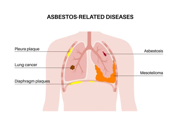 stock vector Asbestos related diseases. Pleura and diaphragm plaque, lung cancer, asbestosis, and mesothelioma tumor cells. Respiratory system illness. Shortness of breath, pain in chest flat vector illustration.