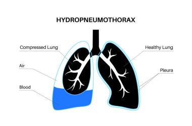 Hemopnömotoraks akciğer hastalığı. İki tıbbi durum pnömotoraks ve hemotoraks karışımı. Öksürük, göğüs ağrısı, nefes darlığı. Sağlıksız iç organlar. Solunum sistemi illüstrasyonu