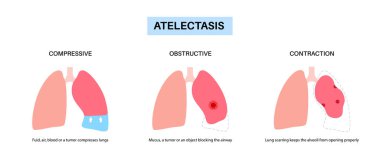 Atelektazi hastalığı anatomik poster. Tamamen ya da kısmi çöküş ya da akciğerin kapanması. Azaltılmış ya da gaz değişimi yapılmamış. Ciğerler alveol sıvısıyla dolu. Solunum sistemi düz vektör çizimi