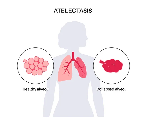 Affiche Anatomique Maladie Atelectasis Affaissement Complet Partiel Fermeture Poumon Échange — Image vectorielle