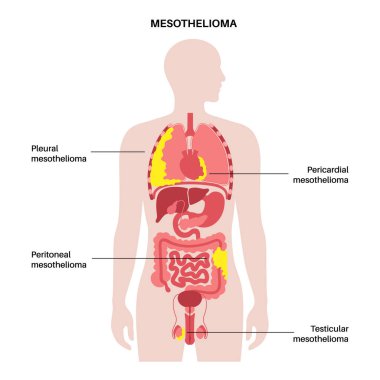 Types of mesothelioma tumor. Cancer cells spreading in lung, heart, intestine and testicles. Pleural, pericardial, peritoneal and testicular mesothelioma. Asbestos related diseases vector illustration clipart