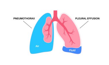 Plevral efüzyon ve pnömotoraks. Sıvı veya hava göğüs boşluğu. Yaygın akciğer hastalıkları. Öksürük, göğüs ağrısı, nefes darlığı. Solunum sisteminde sağlıksız iç organlar düz vektör çizimi