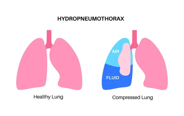Hemopneumotórax Enfermedad Pulmonar Combinación Dos Condiciones Médicas Neumotórax Hemotórax Tos — Vector de stock