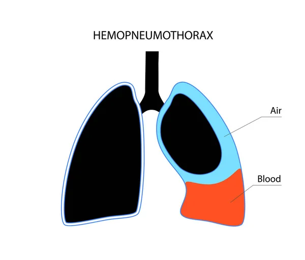 Хвороба Легенів Гемопневмоторакс Поєднання Двох Медичних Станів Пневмоторакс Гемоторакс Кашель — стоковий вектор
