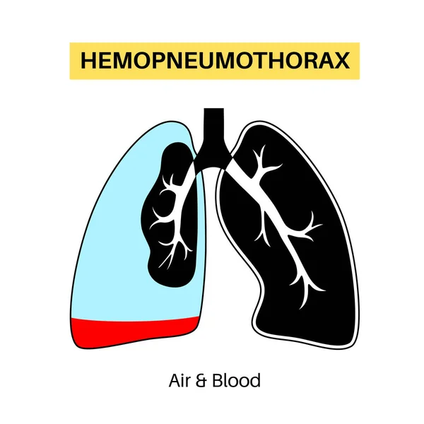 吐き気性肺疾患 2つの医療条件の組み合わせ気胸と血胸 胸の痛み 呼吸困難 不健康な内臓だ 呼吸器系図 — ストックベクタ
