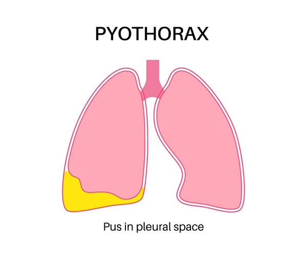 PyothoraxとPleural Empyema 肺炎症性疾患 胸腔および心臓領域への感染 胸の痛み呼吸困難 不健康な内臓だ 呼吸器系のプラスまたは細菌 — ストックベクタ