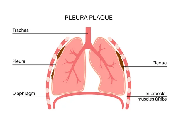 Pleuraplaque Medizinisches Plakat Asbestbedingte Lungenerkrankungen Verdicktes Gewebe Menschlichen Körper Erkrankungen — Stockvektor