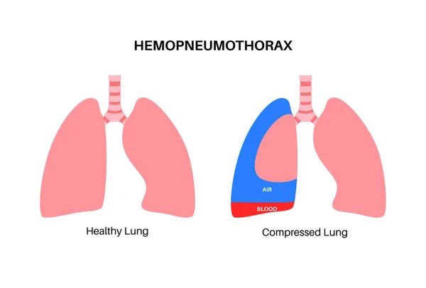 肺气胸疾病 合并两种医学症状 气胸和血胸 胸部疼痛 呼吸困难 内部器官不健康 呼吸系统示例 — 图库矢量图片