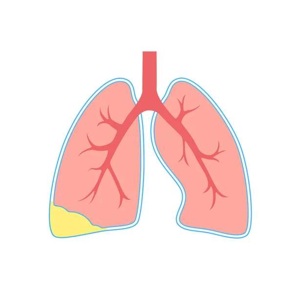 Піоторакс Плевральна Ембріона Запальні Захворювання Легенів Інфекція Грудній Порожнині Області — стоковий вектор