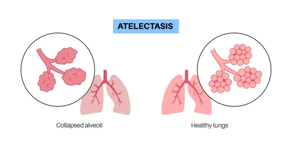 Atelectasis 해부학 포스터 완전하거나 부분적 폐쇄입니다 교환의 폐포에 액체로 호흡계 — 스톡 벡터