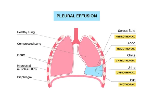胸腔积液海报 肺和胸腔组织层之间的流体 常见的肺部疾病 胸部疼痛 呼吸困难 呼吸系统内不健康的内部器官 — 图库矢量图片