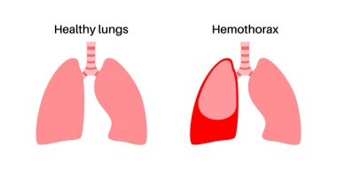 Hemothorax disease. Blood collects in pleural cavity. Lungs collapse, failure and disorder. Comparison of healthy and damaged lungs. Unhealthy internal organs. Respiratory system vector illustration clipart