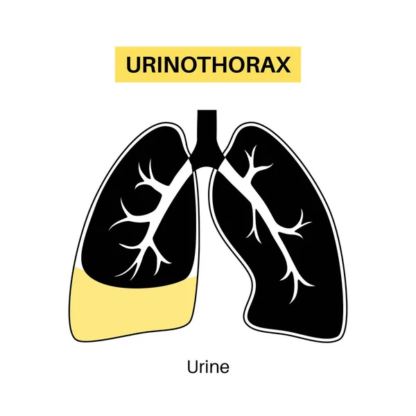 Urinothorax Ziekte Urine Verzamelt Zich Vloeistof Gevulde Holte Longen Pijn — Stockvector