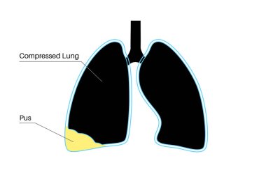 Pyothorax ve plevral empyema. Ciğerleri iltihaplanmış. Göğüs boşluğu ve kalp bölgesinde enfeksiyon. Göğüs ağrısı, nefes darlığı. Sağlıksız iç organ. Solunum sisteminde iltihap ya da bakteri