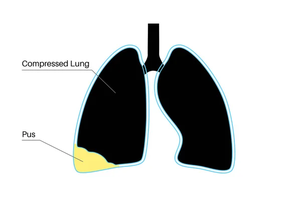 Піоторакс Плевральна Ембріона Запальні Захворювання Легенів Інфекція Грудній Порожнині Області — стоковий вектор