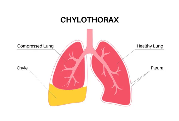 チロソラックス病 肺および胸壁の組織の層間のリンパ液 重度の咳 呼吸困難 不健康な内臓だ 呼吸器系ベクトル図 — ストックベクタ