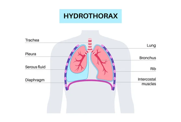Hydrothoraxová Plicní Nemoc Nezánětlivá Sbírka Porézních Tekutin Pleurální Dutině Silný — Stockový vektor
