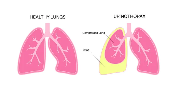 Urinothorax 소변은 액체가 공간에서 모읍니다 호흡기 문제들 건강하지 일러스트 — 스톡 벡터