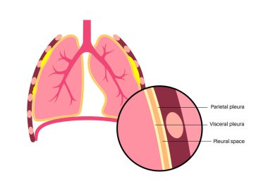 Plevral plaket tıbbi poster. Asbest bağlantılı akciğer hastalığı. İnsan vücudunda kalınlaşmış doku, solunum sistemi hastalığı. Nefes darlığı, kanlı öksürük, göğüs ağrısı düz vektör çizimi.