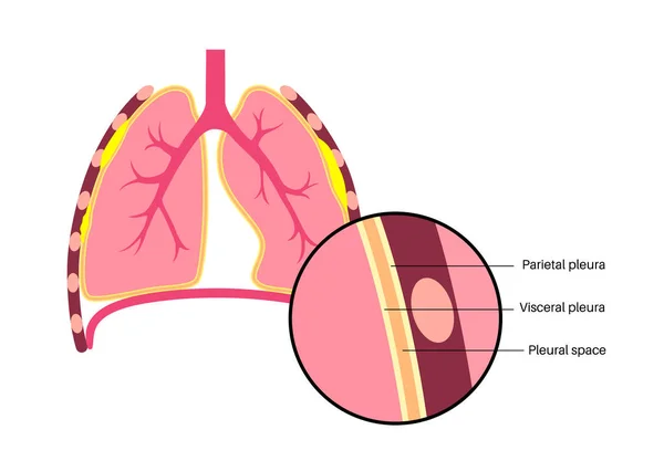 胸板医療ポスター アスベスト関連肺疾患 人間の体内の組織の肥厚 呼吸器系疾患 呼吸困難 胸痛フラットベクトルイラスト — ストックベクタ