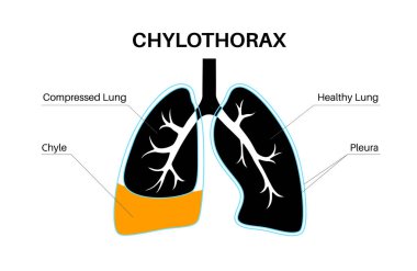 Chylothorax hastalığı. Akciğerlerdeki doku katmanları ve göğüs duvarı arasında lenfatik sıvı var. Şiddetli öksürük, göğüs ağrısı, nefes darlığı. Sağlıksız iç organlar. Solunum sistemi vektör çizimi