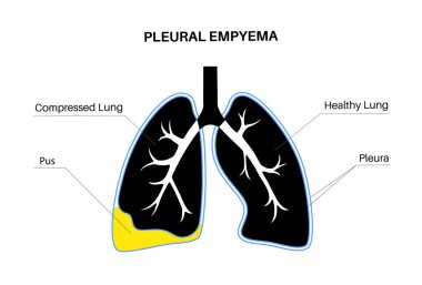 Pyothorax ve plevral empyema. Ciğerleri iltihaplanmış. Göğüs boşluğu ve kalp bölgesinde enfeksiyon. Göğüs ağrısı, nefes darlığı. Sağlıksız iç organ. Solunum sisteminde iltihap ya da bakteri