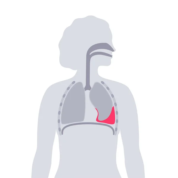 Maladie Hémothorax Sang Accumule Dans Cavité Pleurale Affaissement Des Poumons — Image vectorielle