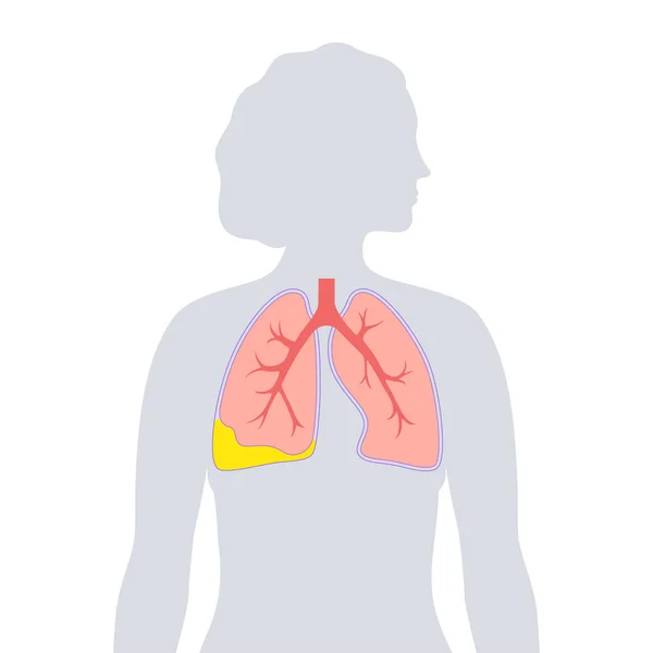 Πυθοράξ Και Υπεζωκότα Φλεγμονή Των Πνευμόνων Μόλυνση Στην Θωρακική Κοιλότητα — Διανυσματικό Αρχείο