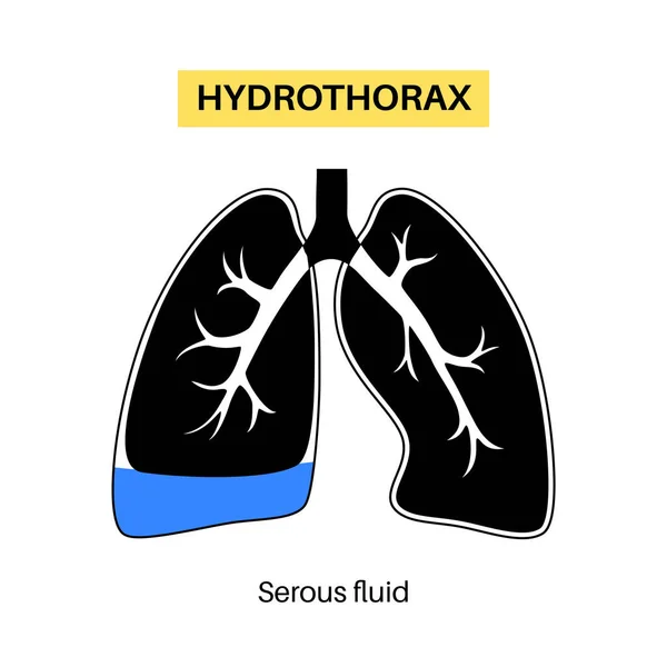 Doença Pulmonar Por Hidrotórax Coleção Líquido Seroso Não Inflamatório Cavidade —  Vetores de Stock