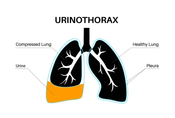ウリノソーラ病 尿は肺の水分で満たされた空洞に集められます 胸の痛み 呼吸困難や呼吸器系の概念の他の問題 不健康な内臓のベクトル図 — ストックベクタ