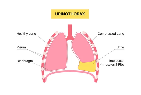 Urinothorax Sjukdom Urin Samlas Vätskefylld Hålighet Lungorna Bröstsmärta Andningssvårigheter Och — Stock vektor