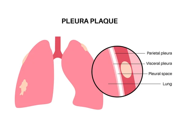 Cartel Médico Placa Pleural Enfermedad Pulmonar Relacionada Con Amianto Tejido — Archivo Imágenes Vectoriales